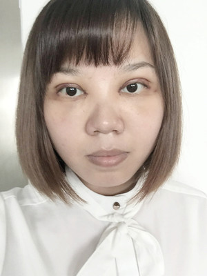 做了双眼皮多项整形手术，大家来看看果如何