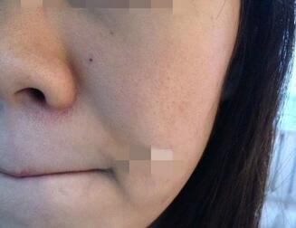 北京欧华像素激光去痘印痘坑 果很棒哦~