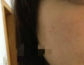 北京欧华像素激光去痘印痘坑 果很棒哦~