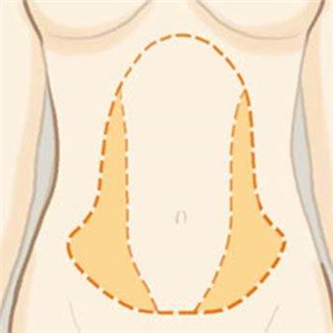 京韩做腰腹吸脂四个月的恢复照片，乔爱军医生的技术很好哦~