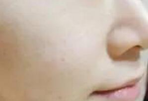 白瓷娃娃缓解一次后,皮肤能直观看出来水润白皙紧致了一些