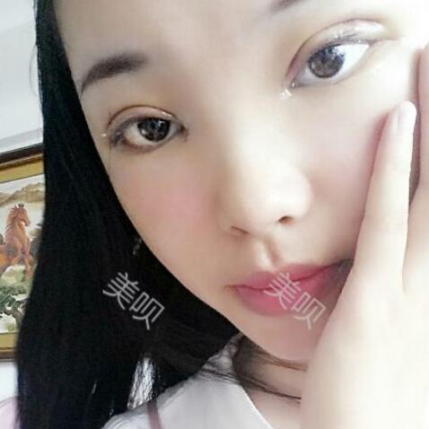 给大家分享下我割双眼皮的恢复全过程希望对大家有帮助