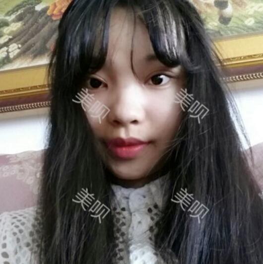 给大家分享下我割双眼皮的恢复全过程希望对大家有帮助