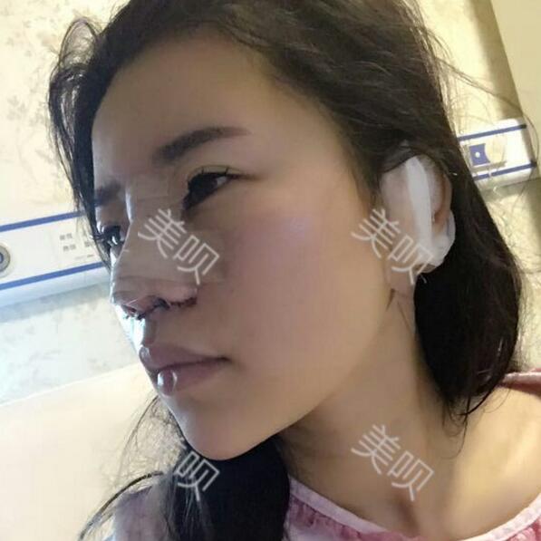 我的综合隆鼻半个月的恢复历程