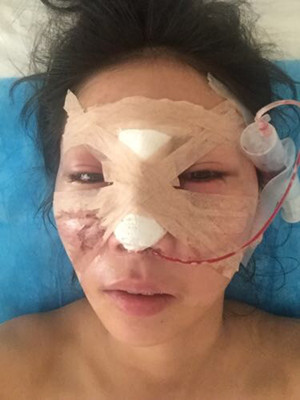 隆鼻手术前后过程对比图，真实案例分享