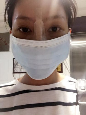 隆鼻手术前后过程对比图，真实案例分享