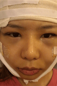 磨骨+下巴矫正手术前后过程(胆小勿入!)真实案例分享