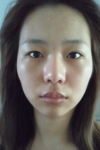 磨骨+下巴矫正手术前后过程(胆小勿入!)真实案例分享