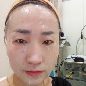 激光祛斑20天后的图片 北京欧华王芳