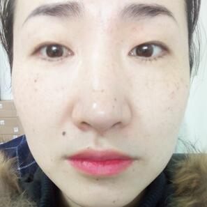 激光祛斑20天后的图片 北京欧华王芳