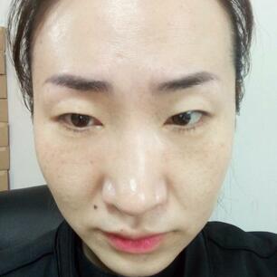 激光祛斑20天后的图片 北京欧华王芳