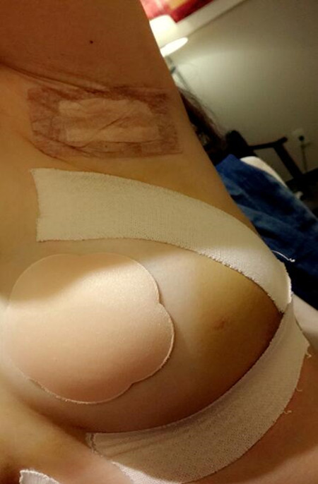 小胸和大胸就差一个李鸿君做的假体隆胸手术