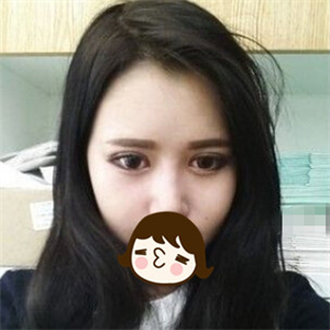 去年做的自体脂肪隆鼻手术，晒一下前后对比果图片~