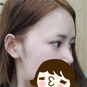 去年做的自体脂肪隆鼻手术，晒一下前后对比果图片~