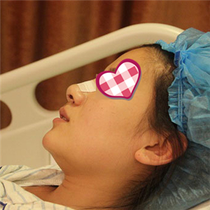 分享我自体软骨隆鼻前后对比果图片和恢复过程，在爱斯克做的哦~