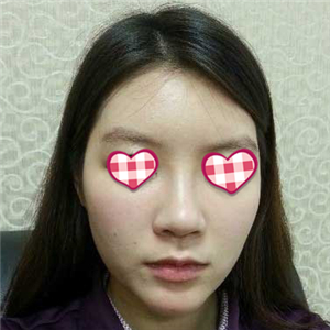 分享我自体软骨隆鼻前后对比果图片和恢复过程，在爱斯克做的哦~