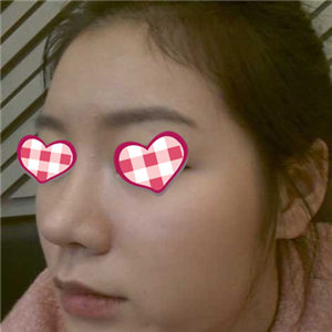 分享我自体软骨隆鼻前后对比果图片和恢复过程，在爱斯克做的哦~