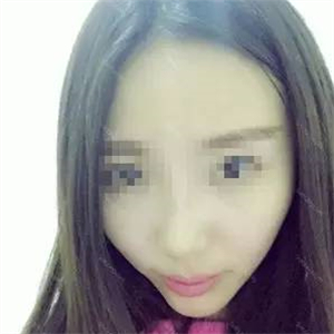 去年做了自体耳软骨隆鼻手术，看看我的恢复过程照片，前后变化大~