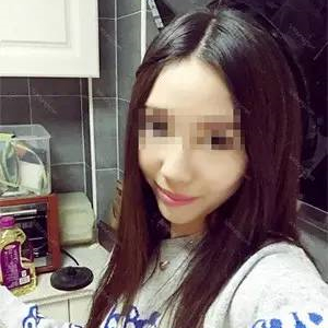 去年做了自体耳软骨隆鼻手术，看看我的恢复过程照片，前后变化大~