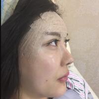 自体脂肪面部填充——丰太阳穴丰额头恢复过程真实案例分享