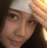 自体脂肪面部填充——丰太阳穴丰额头恢复过程真实案例分享