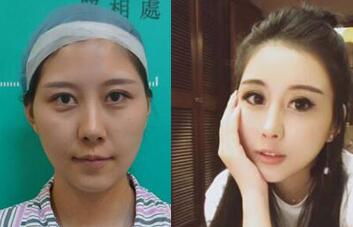 自体脂肪丰太阳穴和丰额头前后对比图