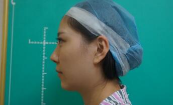 面部填充整形前后对比图和恢复过程经历分享给大家