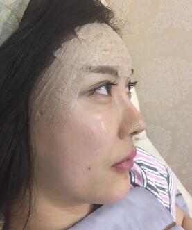 自体脂肪填充面部术后恢复图