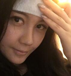 自体脂肪面部填充太阳穴和额头第三天