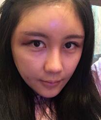 自体脂肪面部填充太阳穴和额头