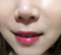 注射玻尿酸除皱价格3600元，术后果分享