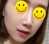 注射玻尿酸除皱价格3600元，术后果分享