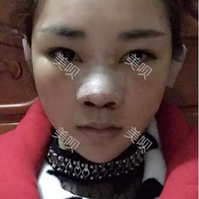 给大家分享在长沙鹏爱做的膨体隆鼻近一个月的恢复过程