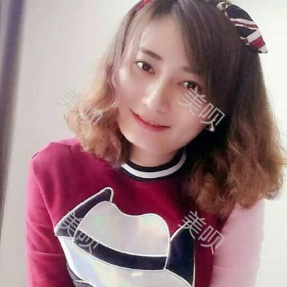 玻尿酸垫下巴后改变了我的大饼脸果漂亮妥妥的