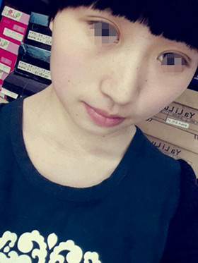 做了切开双眼皮手术，现在恢复的还不错哦