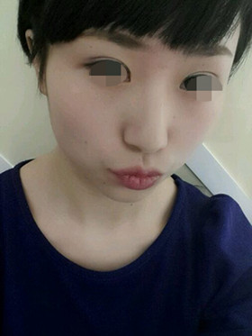 做了切开双眼皮手术，现在恢复的还不错哦