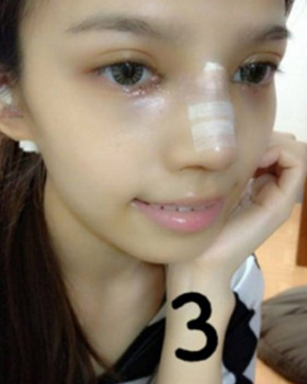 记录了隆鼻三个月前后的恢复过程，希望可以帮到有需要的朋友