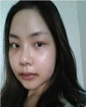 韦敏做的颧骨磨下颌角整形手术果真的很棒
