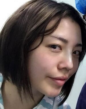 圆钝的鼻子做了硅胶假体隆鼻+垫鼻尖后超精致