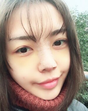 圆钝的鼻子做了硅胶假体隆鼻+垫鼻尖后超精致
