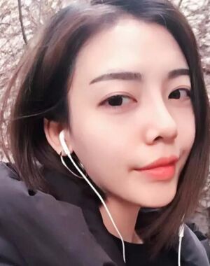 圆钝的鼻子做了硅胶假体隆鼻+垫鼻尖后超精致