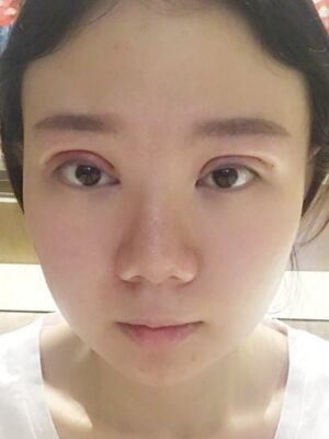 双眼皮失败修复拯救了我丑到哭的眼睛