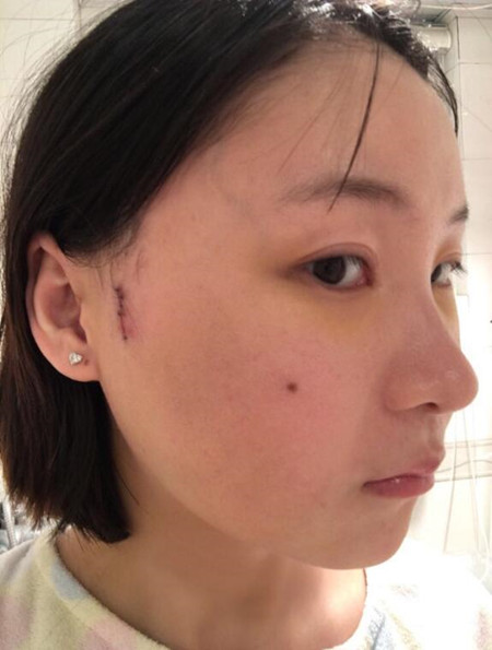 磨下颌角加颧弓截骨降低让我拥有女神高颜值