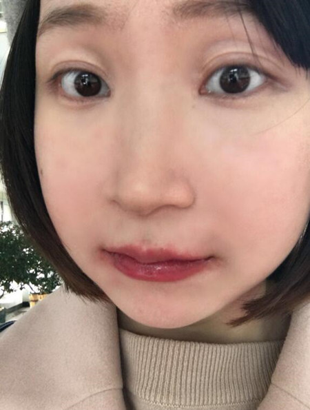 磨下颌角加颧弓截骨降低让我拥有女神高颜值