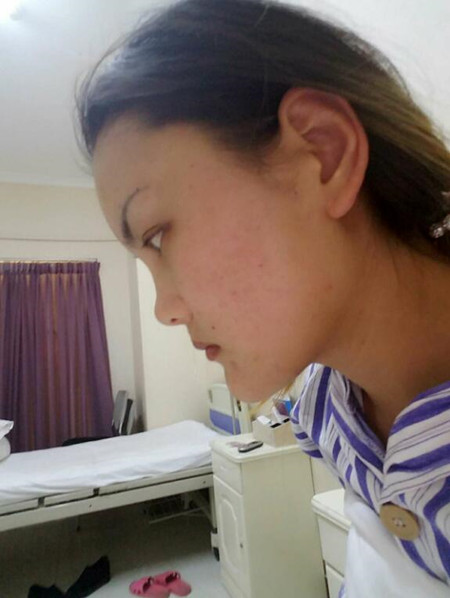 和大家分享一下我做自体脂肪面部填充的经历 还有果图哦