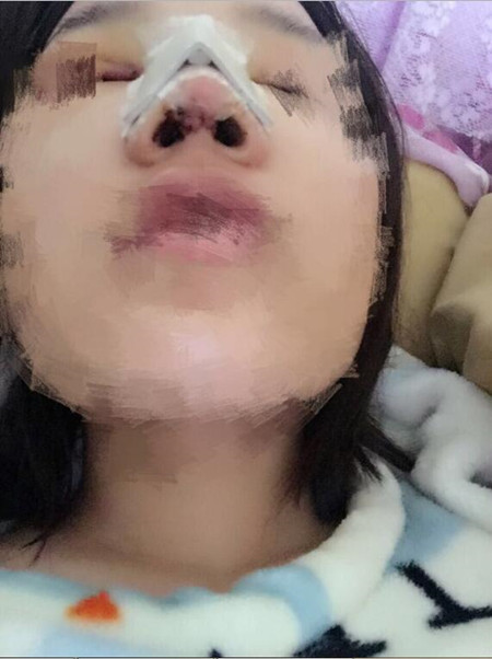 隆鼻整形手术让我的塌鼻子重获新生