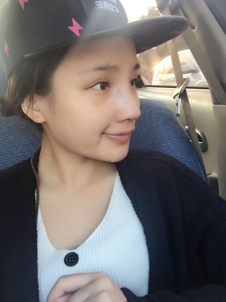 隆鼻整形手术让我的塌鼻子重获新生