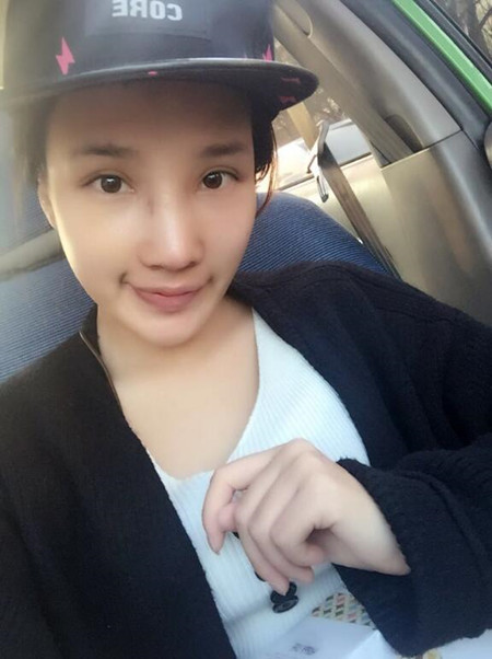 隆鼻整形手术让我的塌鼻子重获新生