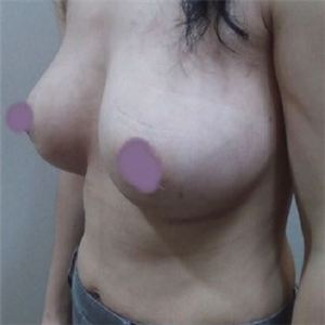 自体脂肪隆胸四个月了，晒一下恢复过程和前后对比果图片~