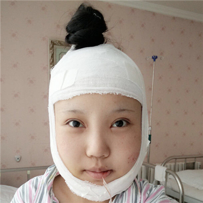 磨下颌角手术+隆鼻前后对比果图片分享，高占巍做的哦~